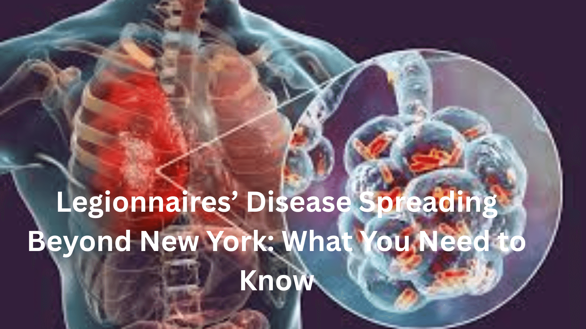 Legionnaires’ Disease Spreading Beyond New York What You Need to Know